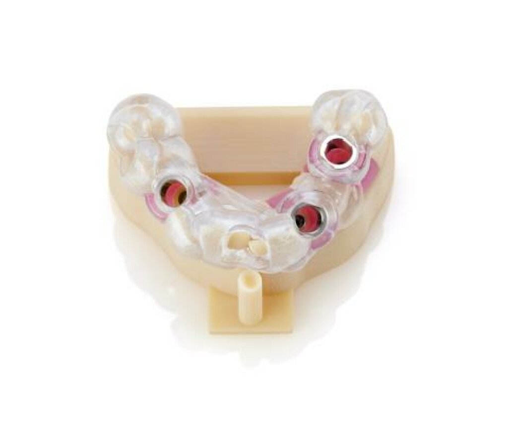 Gingival Maske 3D Druck Dental.